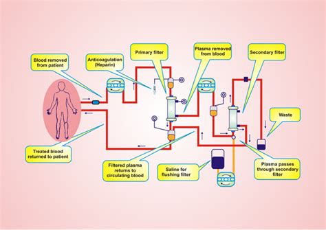 Double-filtration plasmapheresis (DFPP) is a filter-based therapeutic... | Download Scientific ...