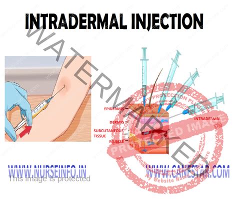 INTRADERMAL INJECTION - Nurse Info