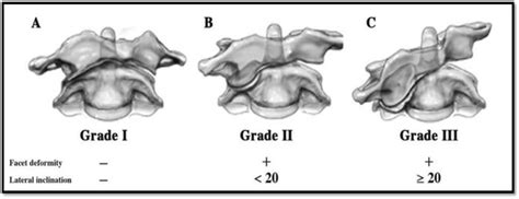 Acute Atlantoaxial Rotary Subluxation (AARS) | Pediatric Orthopaedic Society of North America ...