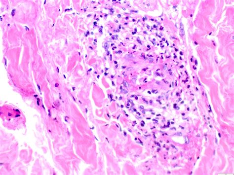 Leukocytoclastic Vasculitis Histology