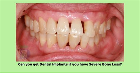 Can you get Dental Implants if you have severe bone loss? - Denta Kings