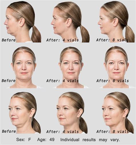 Kybella Cost 2023 - Prices List For Double Chin & Reviews