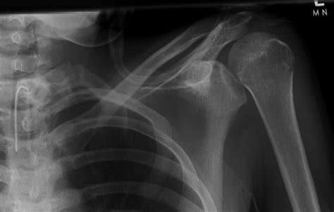 Posterior Shoulder Dislocation • LITFL • Trauma Library