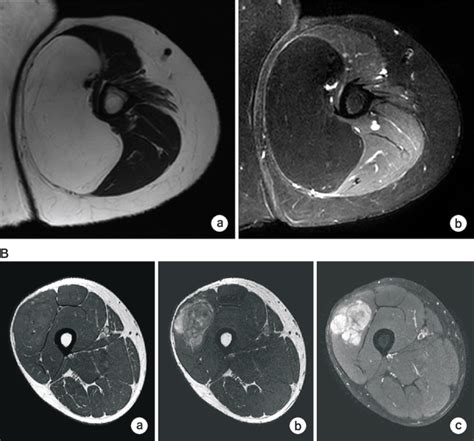 Magnetic resonance imagings (MRIs) of lipoma (A), liposarcoma (B,... | Download Scientific Diagram