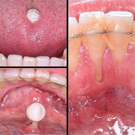 Oral health risks of tongue piercings | News | Dentagama