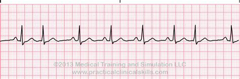 Junctional Rhythms ECG Interpretation