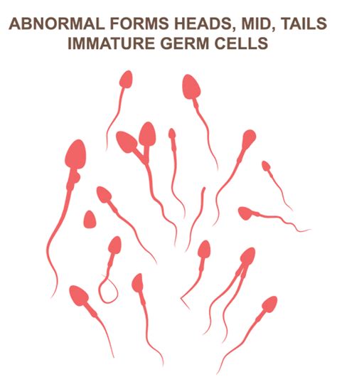 Teratospermia: definition, causes, symptoms and treatment – Mediologiest