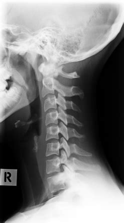 Cervical Vertebrae Lateral View Labeled