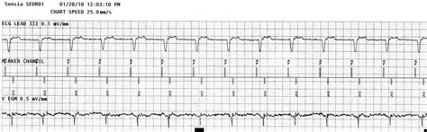 Surface ECG shows retrograde P waves. Intracardiac markers show Ap-Vs ...