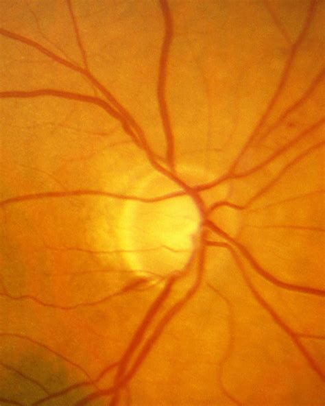 Glaucoma Information Glaucomatous optic disc - Glaucoma Information