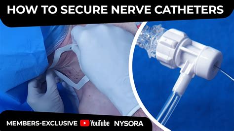 How to secure perineural catheters - Crash course with Dr. Hadzic - YouTube