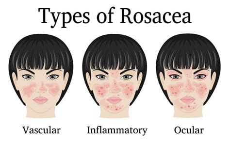 Guide to Ocular Rosacea: Treatment and More – NVISION