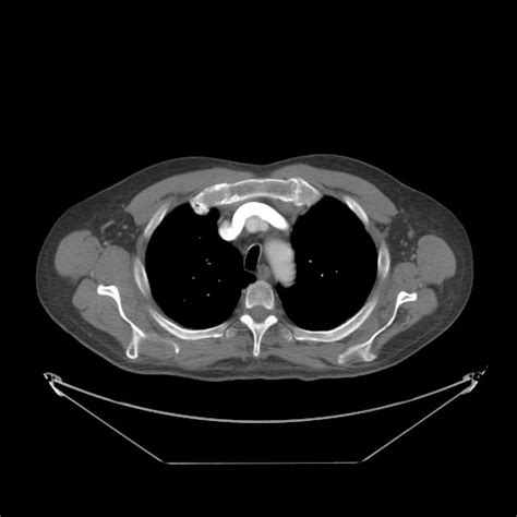 Aortic arch anomalies CT - wikidoc