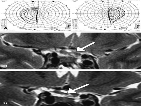 Journal of Neuro-Ophthalmology