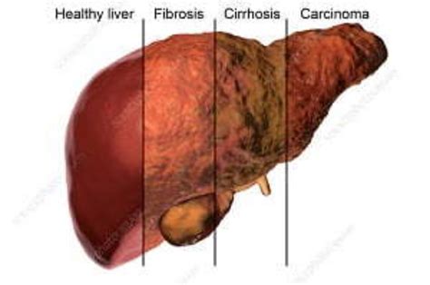 Effects On Liver From Alcohol