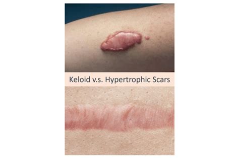 Keloid Acne Scars: What Are They And How To Get Rid of Them? – Dream Plastic Surgery