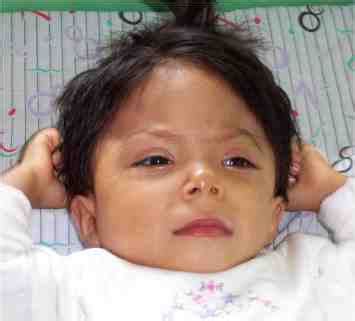 Dismorphic upper facial appearance: trigonocephaly, slight upslanted... | Download Scientific ...