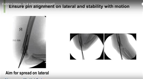 Is Cubitus Varus a Rotational issue? — OrthopaedicPrinciples.com