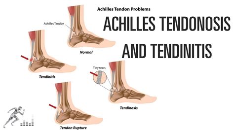 Achilles tendinosis and tendinitis: Signs, symptoms and treatment options - YouTube