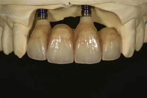 Implant supported zirconia bridge | Dental art, Dental implants, Dental laboratory