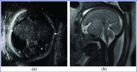 Suprasellar tumour: (a) an axial ultrasound image is showing an... | Download Scientific Diagram