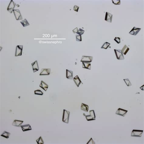 Uric Acid Crystals In Urine