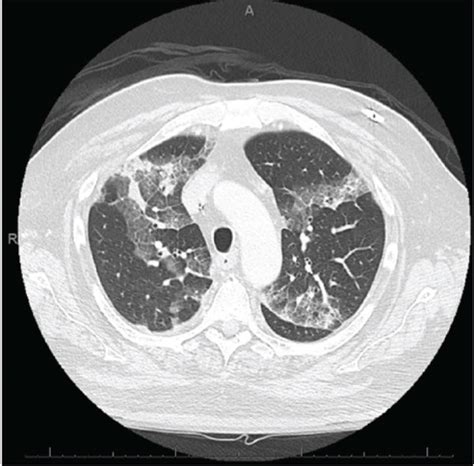 CT scan of the chest with intravenous contrast at day four of ...