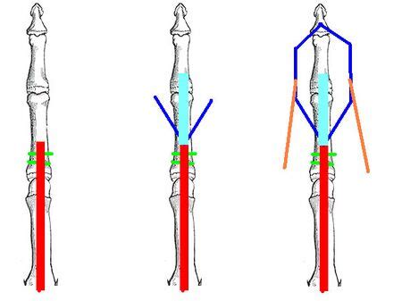 Finger Extensor Tendon Injuries - WikiMSK