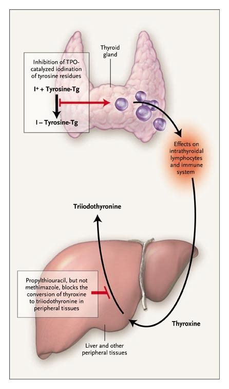 Antithyroid Drugs | NEJM