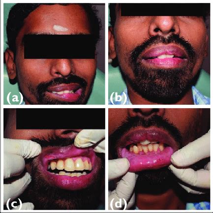 (a) and (b) Uncontrolled Lip Biting. (c) Upper Lip Ulceration. (d)... | Download Scientific Diagram