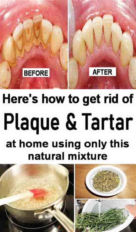 How to remove plaque from teeth? Try This natural remedy. | Plaque ...