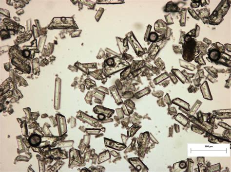 Struvite crystals | Medical Laboratories