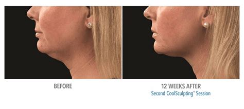 Coolsculpting Double Chin Before & After #1 - Zcosmetic Health