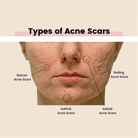 Types of Acne Scars | Albany Laser