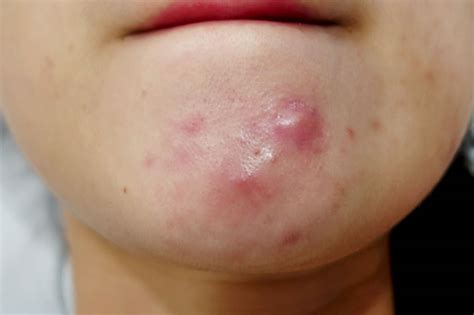 Cystic Acne Causes & Best Treatment To Get Rid of Cystic Acne On Chin