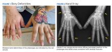 Difluoroethane Inhalant Abuse, Skeletal Fluorosis, and Withdrawal ...