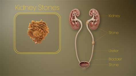 Kidney stones: Causes, Symptoms, Treatment and Medication