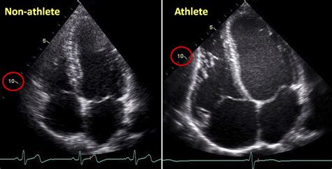 The athlete's heart | Heart