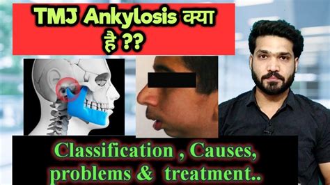 TMJ Ankylosis क्या है ? Classification, causes & treatment - YouTube