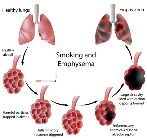 Solved The leading cause of emphysema, a type of chronic | Chegg.com