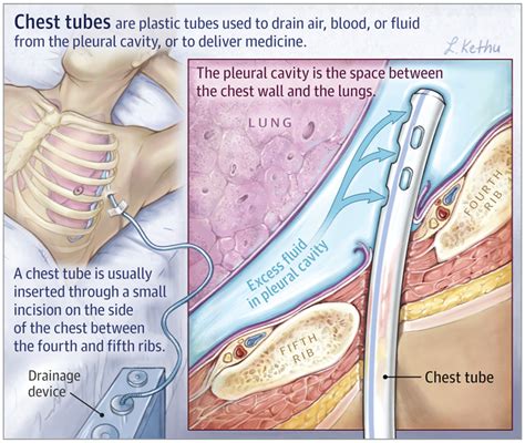 #chest #tubesChest Tubes | Emergency nursing, Nursing school survival ...