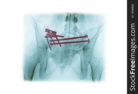 1+ X ray fractured pelvis Free Stock Photos - StockFreeImages