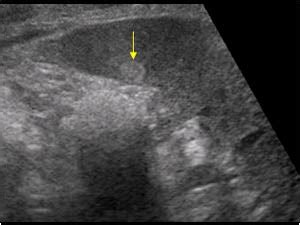 Abdomen and retroperitoneum | 1.4 Spleen : Case 1.4.2 Benign mass lesion of the spleen ...