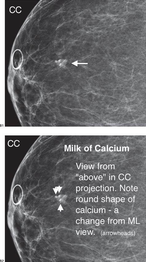 Milk Of Calcium Cyst Ultrasound