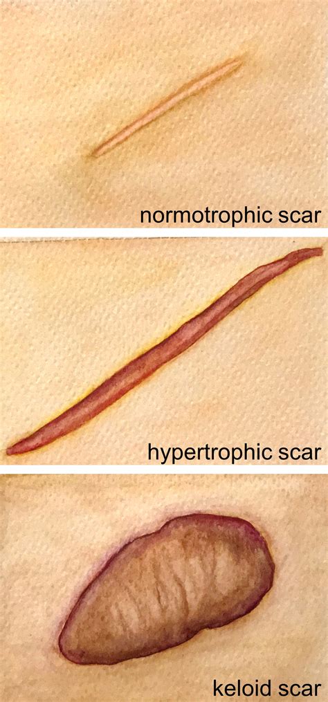 Hypertrophic Scar Vs Keloid