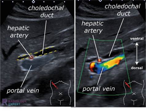 Hepatic Artery Ultrasound