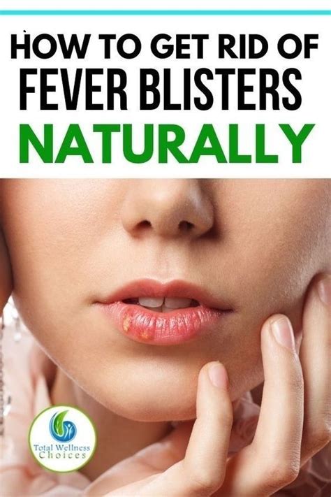 Home Remedies for Fever Blisters on the Lips to Help You Fight Cold ...