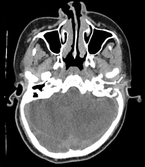 -Axial CT scan soft tissue window shows soft tissue density filling the ...