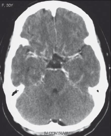 Contrast-enhanced CT scan at the level of the basal cisterns, showing ...