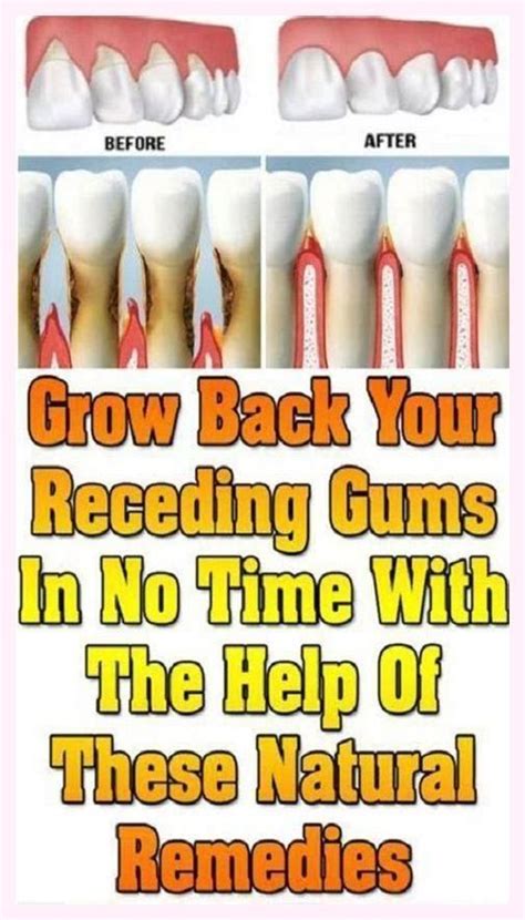 Natural Remedies | Receding gums, Natural remedies, Teeth health